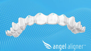 Angel Aligner v&nbsp;Evropě přejmenovává torzní výstupky na „tlakové body“